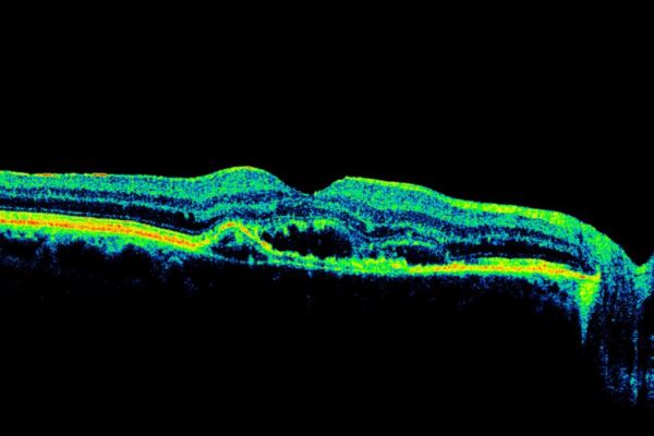 AMD märja vormi OCT-uuring