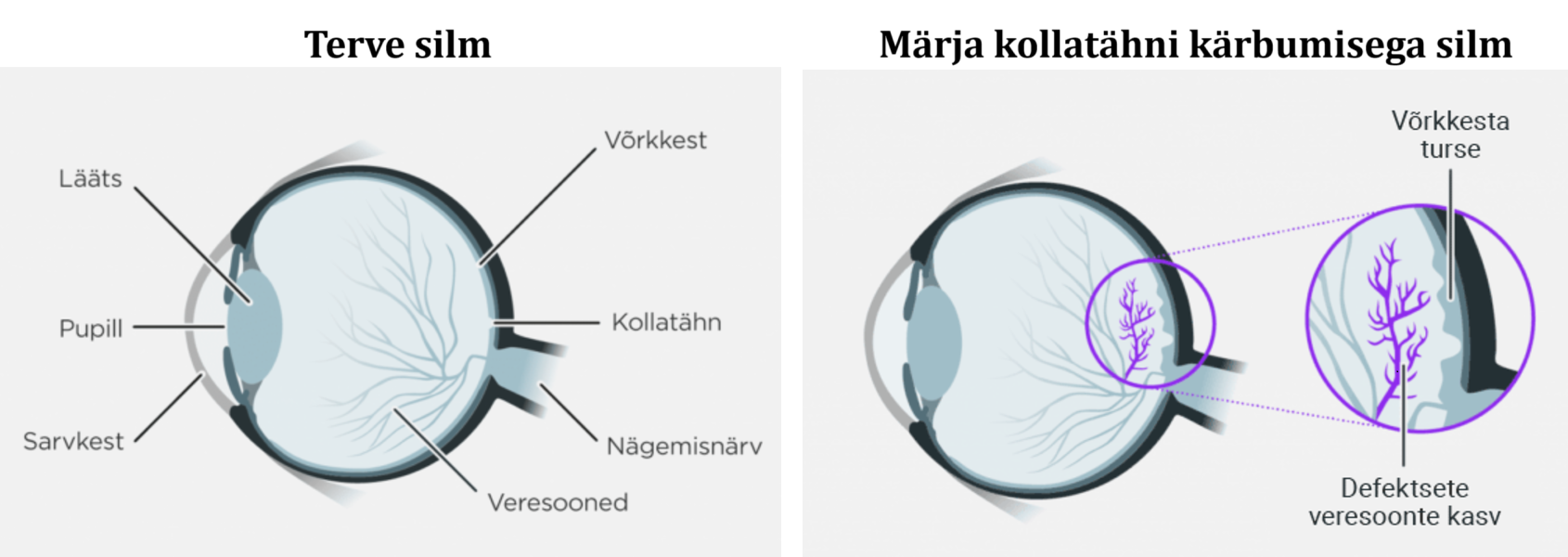 Terve silm ja märja kollatähni kärbumisega silm